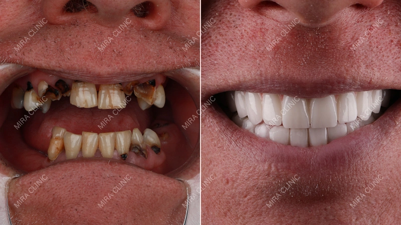 Before and After: Real Back Tooth Restoration Result